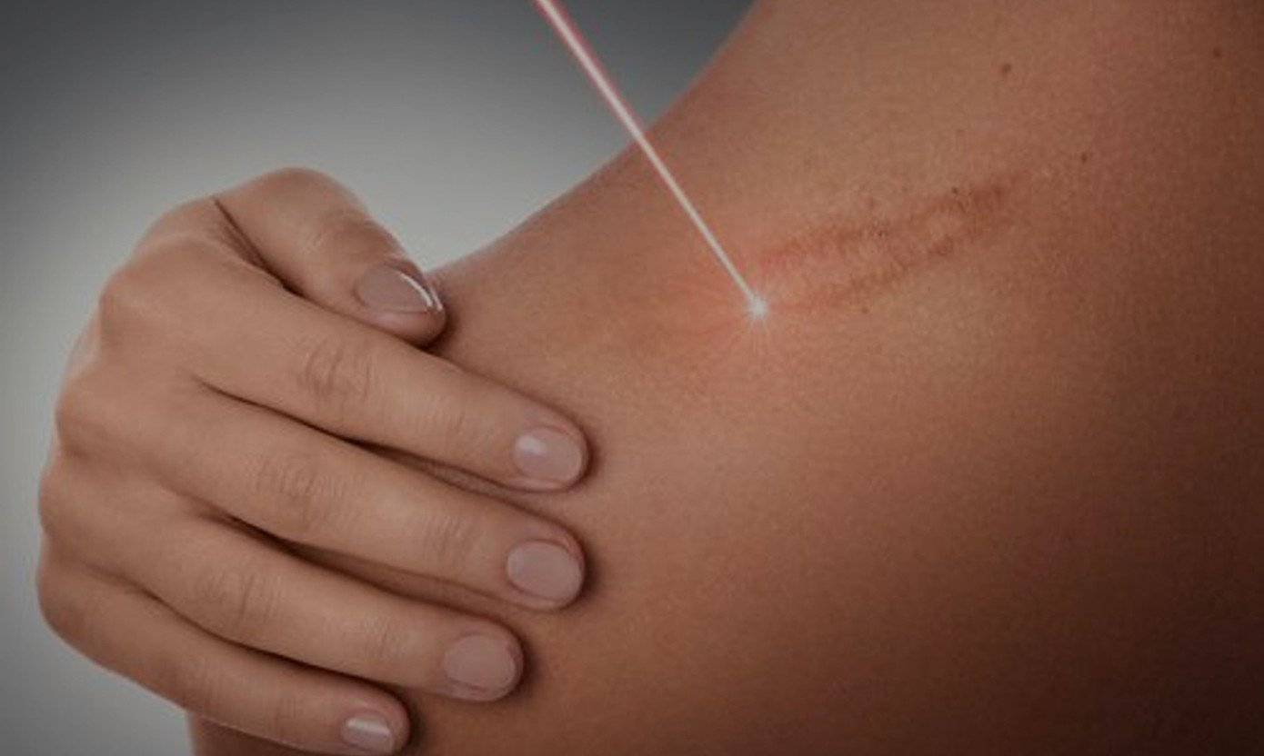 Laser para Cicatriz Queloide
