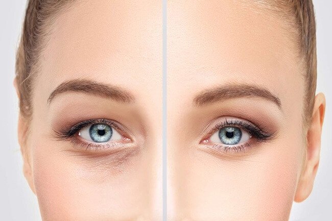 Láser para Ojeras