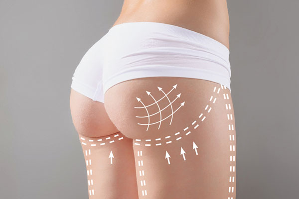 Levantamiento de Glúteo con peptonas