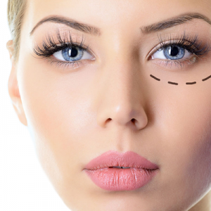 Blefaroplastia sin cirugía