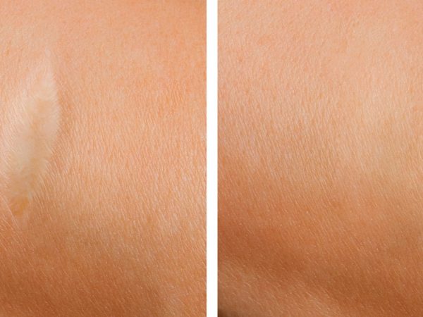 Camuflaje de Cicatrices