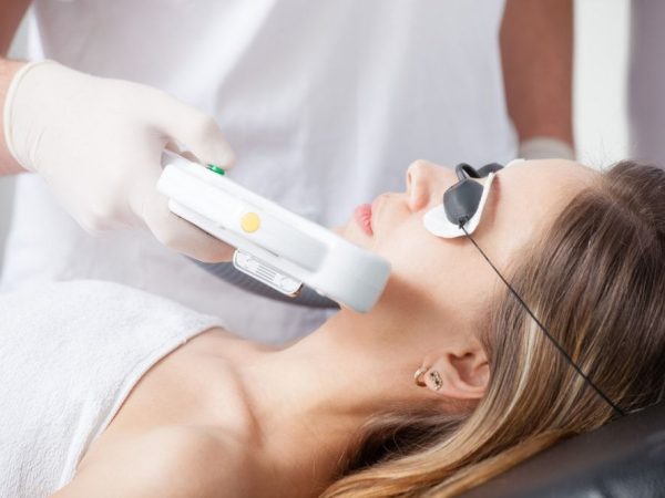 Lasér para Acne 1 ses.