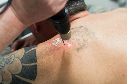 Laser Estético Corporal en Puerto Vallarta